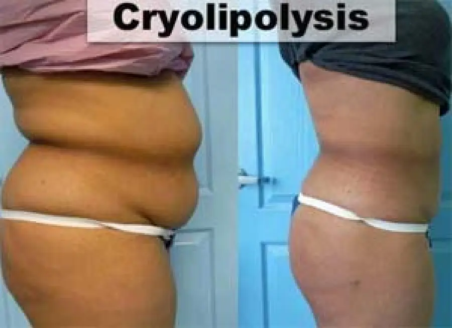 Criolipolisi per eliminare Cellulite e Grasso come funziona