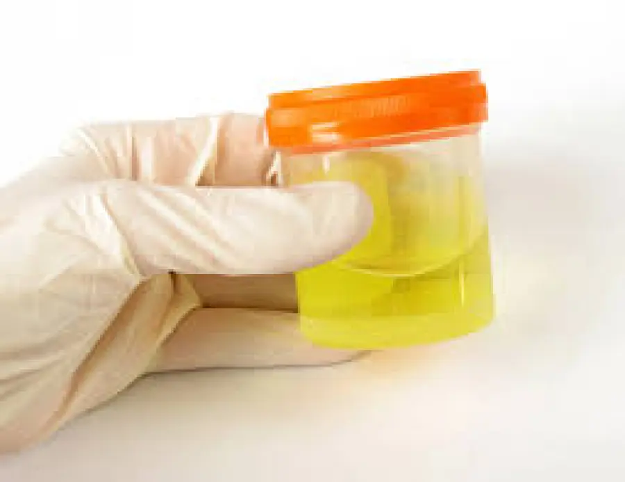 Analisi Urine per controllare la microematuria