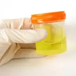 Analisi Urine per controllare la microematuria