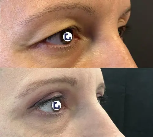 Le 3 domande a cui pensi quando decidi di fare la blefaroplastica superiore