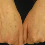 Cosa fare per le Macchie della Pelle sulle Mani