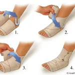 Cavigliera Aircast Funziona per le Distorsioni alla caviglia?