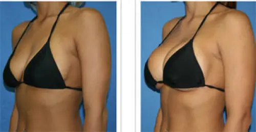 Aumento del Seno con le Protesi e senza Chirurgia