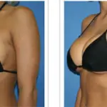 Aumento del Seno con le Protesi e senza Chirurgia