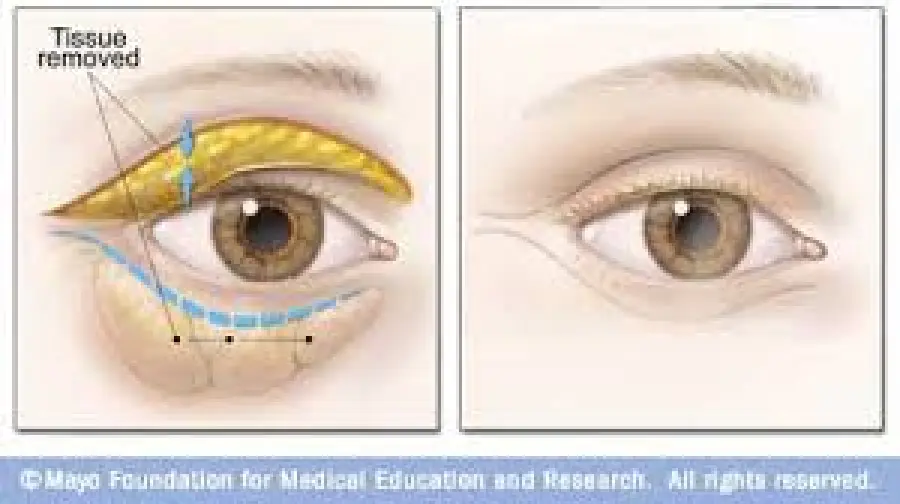 Intervento Chirurgico per eliminare le Borse sotto gli occhi