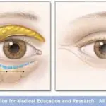 Intervento Chirurgico per eliminare le Borse sotto gli occhi